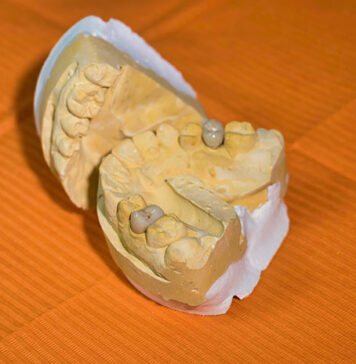 Jaki implant wybrać