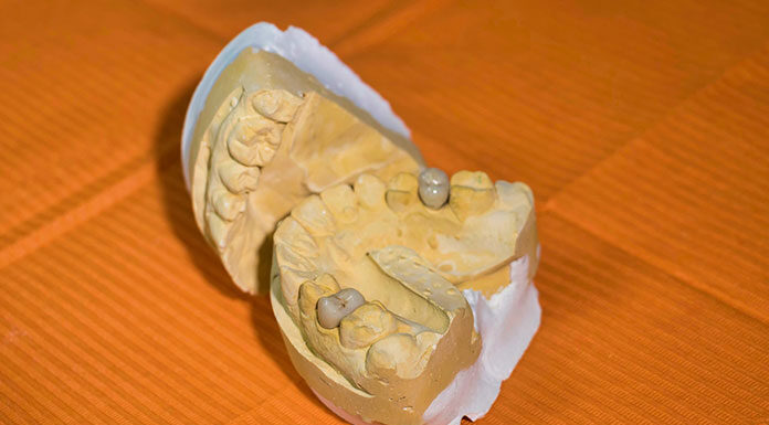 Jaki implant wybrać