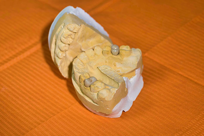 Jaki implant wybrać